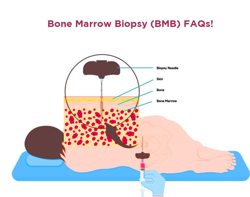 Bone Marrow Procedure & Diagnostics